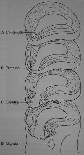 lombocruralgia da ernia discale  Anatomia