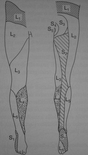 Lombalgia, Lombosciatalgia, Lombocruralgia Clinica Ernia