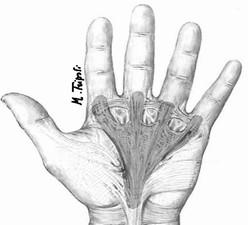 m. di Dupuytren, alluce valgo, osteocondrosi, scoliosi, lombalgia,