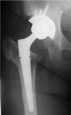 osteotomia con placca e cerchiaggi. A 2 anni, lo stelo risulta correttamente allineato, stabile, ben osteointegrato e senza linee di radiolucenza.