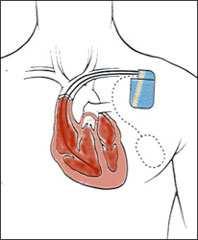 Automatic Implantable Cardioverter Defibrillator (AICD) Indicato in: