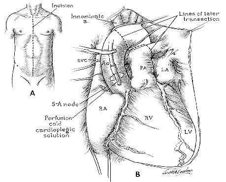 Raffreddamento topico Decompressione ventricolo destro (legatura vena cava superiore, transezione vena cava inferiore all