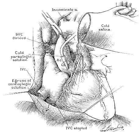 Cardiectomia: - vena cava superiore - vene polmonari inferiori
