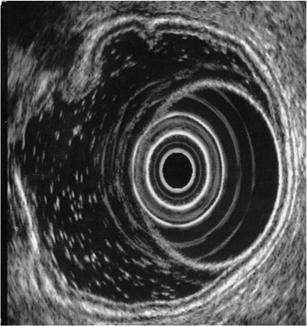 Profondità di penetrazione Parete intestinale 7.