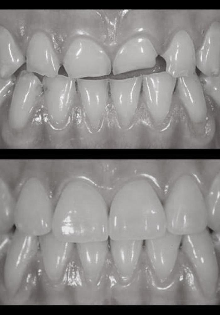 Oggi più che mai mantenere un bel sorriso rappresenta il primo desiderio dei nostri pazienti e, molto spesso, questo risultato può essere ottenuto con materiali e procedure cliniche che salvaguardano