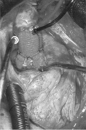 L obiettivo comune di tutte queste tecniche è quello di preservare una valvola aortica, intrinsecamente sana in pazienti con una patologia a