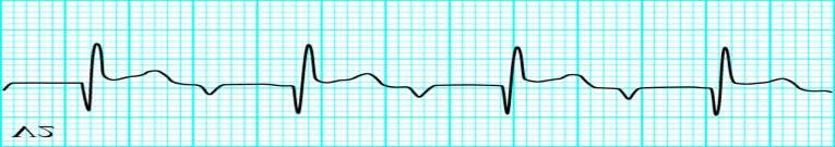 BAV I grado ECG: Ritmo regolare a complessi stretti, FC lenta (40-60 bpm) o normale, prolungato