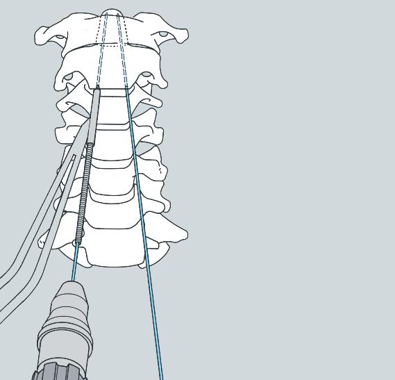 3 Inserire i fili guida Identificare il bordo inferiore del corpo della seconda vertebra cervicale (C2).