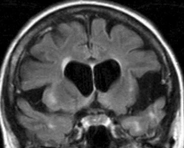 deglutizione Disfagia in SM: correlato imaging Deglutizione