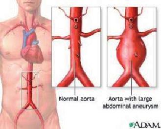 ANEURISMA DELL AORTA ADDOMINALE DEFINIZIONE: l aneurisma è una dilatazione permanente di un tratto arterioso; normalmente si considera aneurismatico un segmento arterioso quando il suo diametro