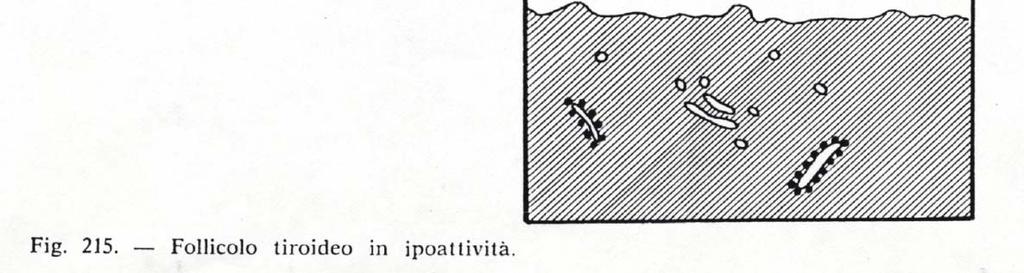 Patologie correlate Ipotiroidismo Dovuto a: Atrofia autoimmune Asportazione chirurgica Sintomi: