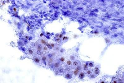 loro contesto una componente cellulare oncocitaria. Oncocytic Mucoepedermoidal Carcinoma Clinicopathologic Description in a Series of 12 Cases Ilan Wienreb, Raja R.