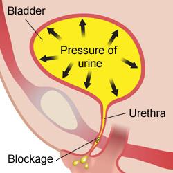 INCONTINENZA URINARIA DA IPERAFFLUSSO La vescica è in sovradistensione perché non può