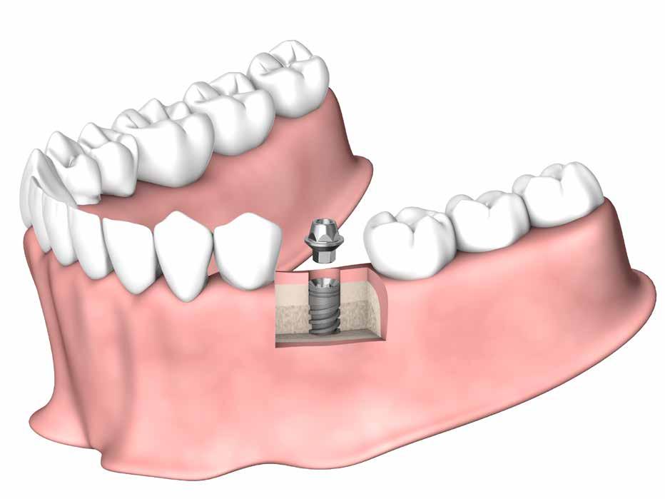 È necessario verificare la posizione definitiva del transfer. 4 Verifica dell altezza dell abutment CLINICO Abutment HBC Altezze disponibili: 6040 0.5mm 6041 1.5mm 6042 2.5mm 1.