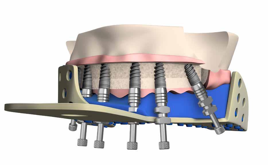 1 Presa d impronta a cucchiaio aperto a livello dell'impianto A CLINICO Transfer Cucchiaio aperto Cucchiaio chiuso Quando vi è un'incertezza circa l altezza o il tipo di abutment da utilizzare