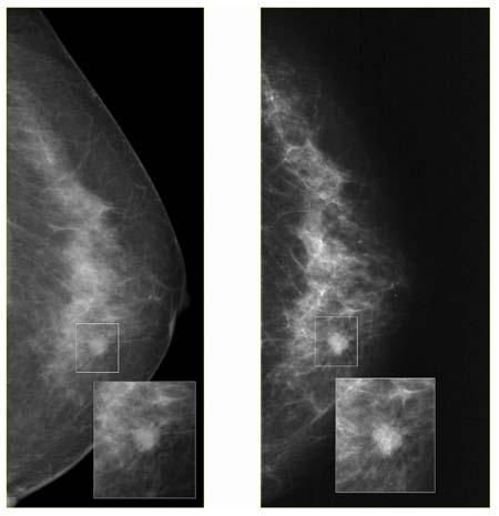 Attività in corso Sviluppo di laboratori mammografici per imaging in contrasto di fase all interno di sincrotroni (SYRMEP BeamLine ELETTRA, Trieste) Sviluppo di nuove sorgenti monocromatiche di