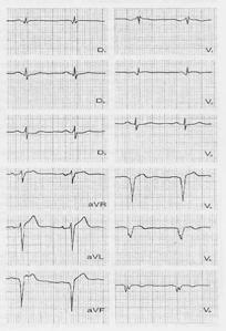 Infarto (complesso QS) Valori enzimatici nell infarto miocardico acuto Scintigrafie cardiache Enzimi Tempi di comparsa Picco Normalizzazione CPK 6-8 h 24-30