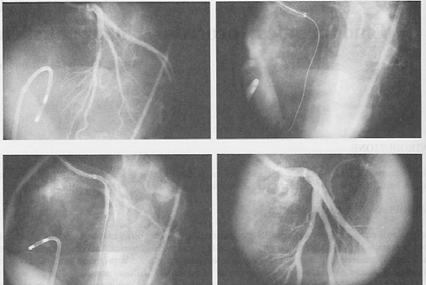 Attraverso il catetere vengono iniettati 5-6 ml di mezzo di contrasto, durante registrazione su CD, usando varie proiezioni radiologiche per