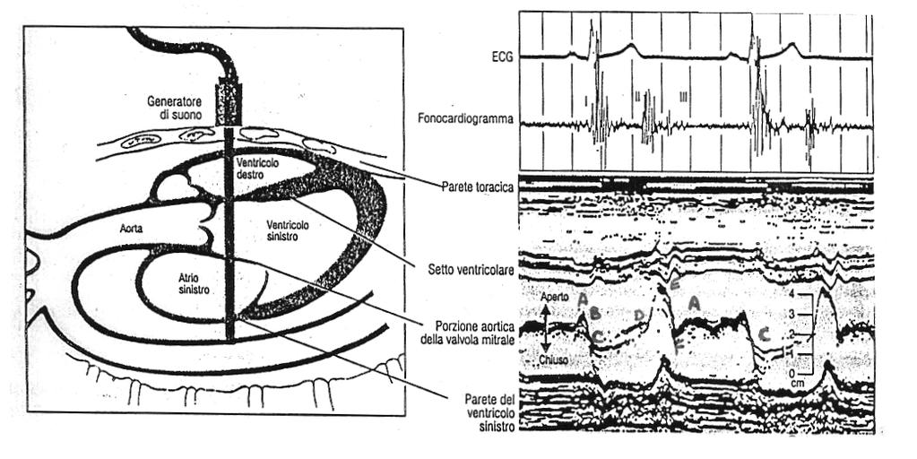 ECOCARDIOGRAFIA Ultrasuoni attraverso la parete toracica vengono riflessi come echi dalle strutture interne.