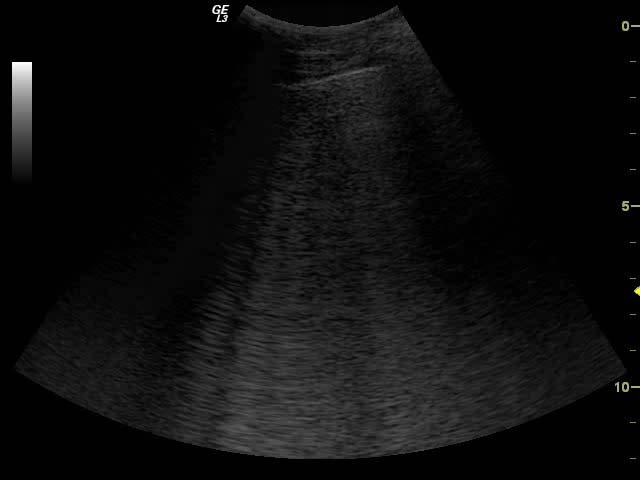 Polmonite Atelectasia Contusione Infarto Neoplasia linee A - rare linee B - assenza di artefatti Artefatti linee B multiple