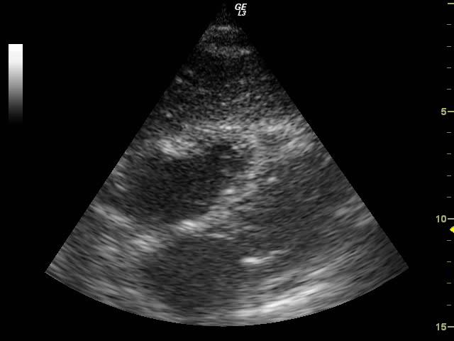 TAMPONAMENTO ECOtorace fluido in pleura