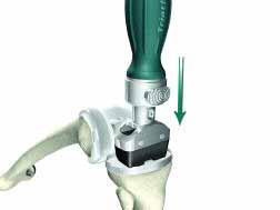 Sistema di protesi di ginocchio Triathlon Protocollo chirurgico > Per assestare ulteriormente la base tibiale, collegare l impattatore sul manico di impattazione.