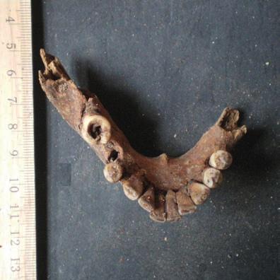 Figura 7: Mandibola di un individuo dalla tomba 3 con molare con carie penetrante. Figura 8: Particolare di un mascellare di un individuo proveniente dalla tomba 3.