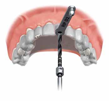 NobelGuide : una pianificazione perfetta per denti perfetti NobelGuide soddisfa le esigenze dei pazienti e