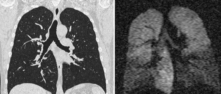 enfisema