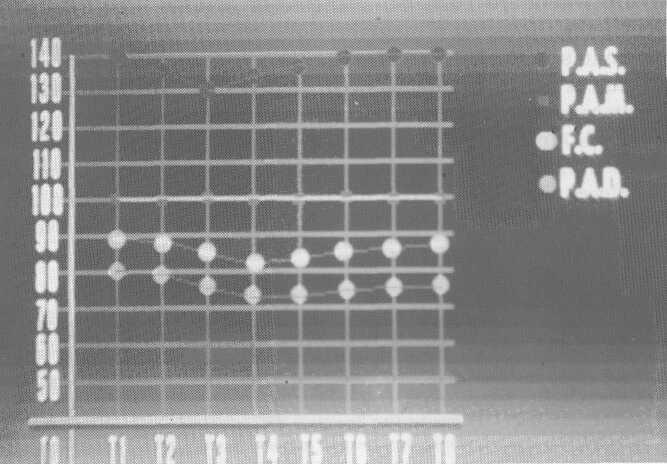 Anestesia subaracnoidea superselettiva nella chirurgia ortopedica maggiore del lettino operatorio, in modo di avere una analgesia metamerica confinata all'arto interessato da T 12-L1 a S3.