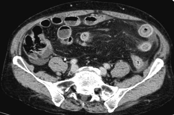 IMT complicato Capitolo 3 45 a Fig. 3.18 a, b. IMT complicato da strangolamento.tcms con mdc ev.