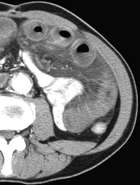 IMT complicato Capitolo 3 53 Fig. 3.24 a-c. IMT complicato da strangolamento.tcms con mdc ev. a Particolare dell ipocondrio sinistro.