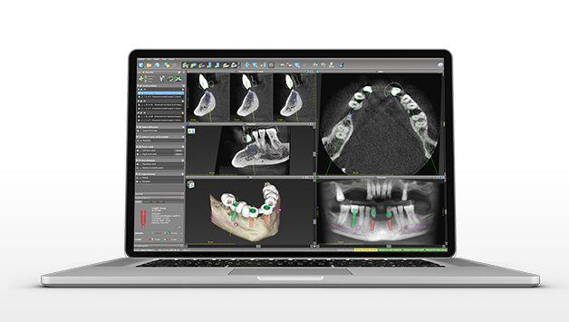 codiagnostix 9.8 codiagnostix è la soluzione implantologica digitale che copre la pianificazione implantare e la progettazione di guide di foratura chirurgiche.