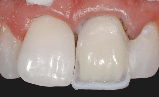 uso di tre materiali differenti, il dentista ha utilizzato Filtek Supreme XT nel colore A2D (Dentina A2) lasciando libera la zona