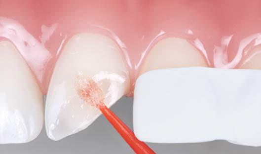 3. Analisi delle tecniche di stratificazione con l uso di un Typodont 3 Isolare i denti adiacenti. Applicare uno strato di adesivo sul Typodont.