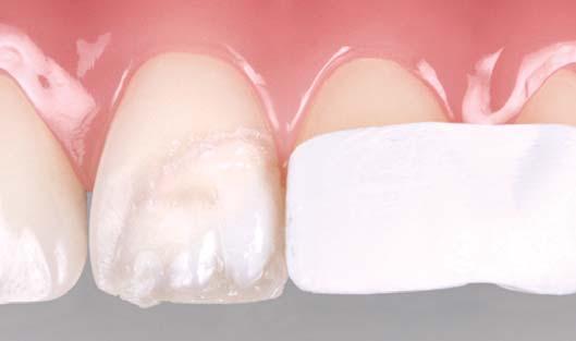 Si consiglia di utilizzare un colore dell opacità Dentina applicandola con uno spessore pari a circa 1/3 dello spessore del dente.