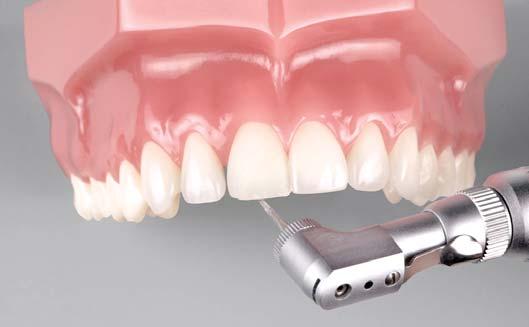 Consiglio estetico: su un tipico dente di Typodont, si consiglia di utilizzare Filtek Supreme XT nel colore WE.