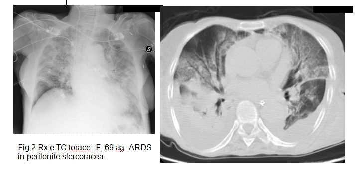 PEEP elevata e Reclutamento polmonare Indicazioni -NIV- Incremento del numero di unità alveolari disponibili per gli scambi gassosi attraverso la somministrazione