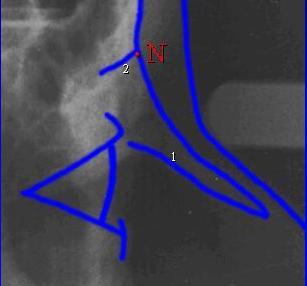 Profilo dei TESSUTI DURI Corticale esterna del frontale: corre parallela al profilo mucoso.