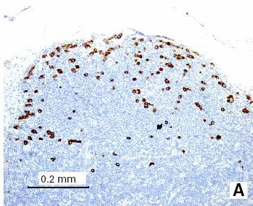 Metastasi linfonodali evidenziate con il protocollo dello studio sono state valutate per dimensioni e numero (diametro, numero di cellule isolate e/o di aggregati) e localizzazione (capsula o