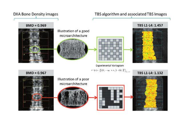 2 TBS insight : un nuovo strumento per identificare i pazienti a rischio di frattura TBS insight è uno strumento software da installare sugli scanner DXA esistenti.