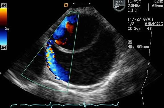 Il paziente è stato sottoposto a ecotrans-esofageo d urgenza che ha