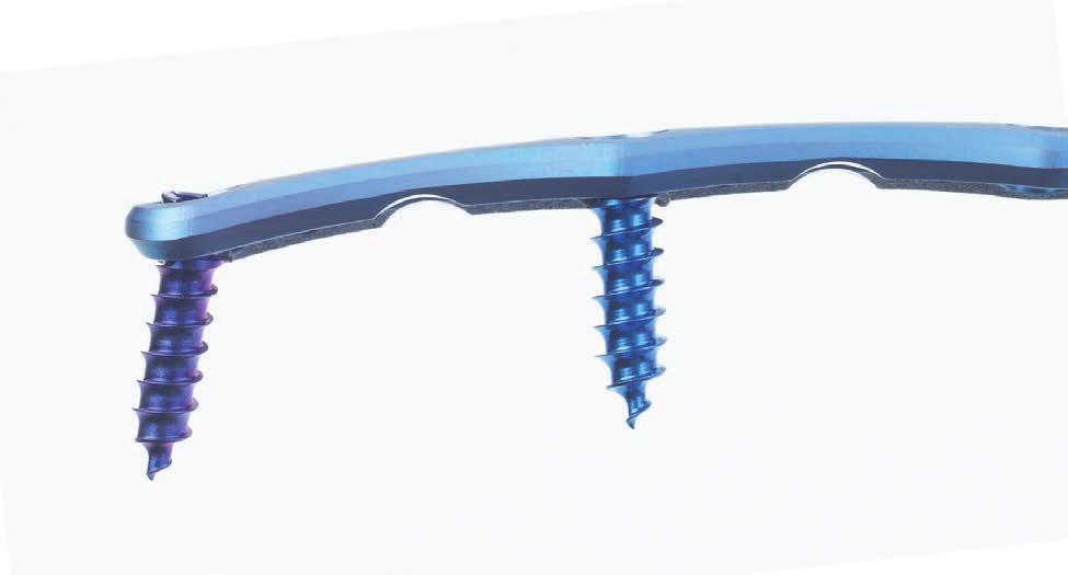 Vectra. Progettato per la flessibilità e la facilità di utilizzo del sistema di placche cervicali anteriori.
