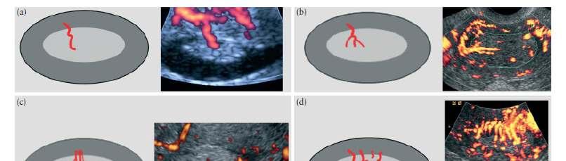 Single dominant VASCOLARIZZAZIONE VASCULAR