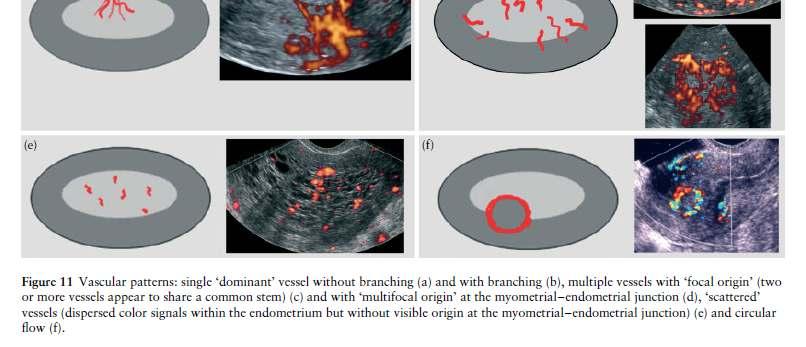 Multiple vessels with focal origin Multiple