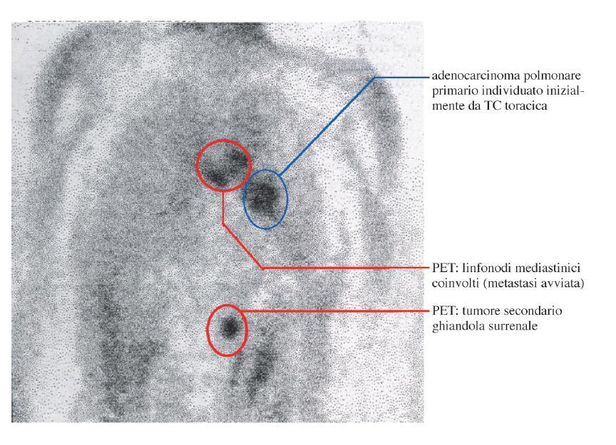 2 Tomografie a emissione di positrone Positron Emission Tomography (PET) Attualmente le immagini PET sono di grande aiuto nella chirurgia dei tumori, poiché