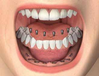 RIABILITAZIONE PROVVISORIA E DEFINITIVA CON ABUTMENT PLAIN Realizzare la struttura come da protocollo standard.