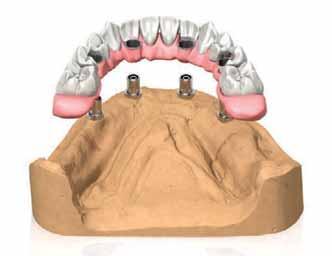 RIABILITAZIONE PROVVISORIA E DEFINITIVA CON ABUTMENT P.A.D. Modellare una travata in resina, inglobando i cilindri calcinabili.