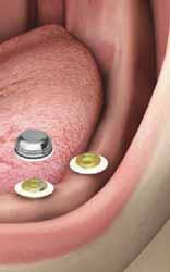 PROTOCOLLI DI UTILIZZO Ancoraggio con Locator abutment Metodo diretto: fasi alla poltrona Scoprire gli impianti, o rimuovere le viti transmucose di guarigione, a seconda che sia stato adottato un