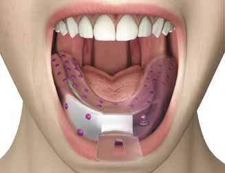 ANCORAGGIO CON ATTACCHI SFERICI Collocare quindi il cucchiaio in situ e attendere i tempi di indurimento secondo le istruzioni del produttore.